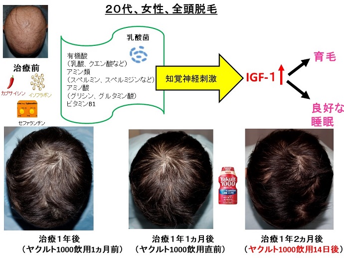 円形脱毛症　病院